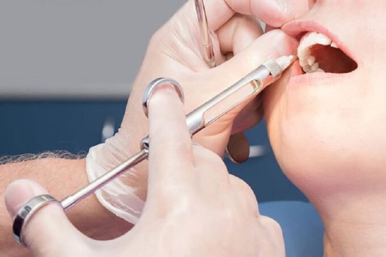 Trồng răng Implant không gây đau vì đã có sự hỗ trợ của thuốc tê