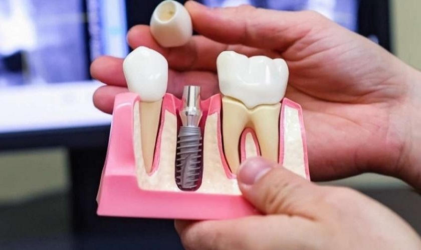 Trồng răng Implant giá bao nhiêu 2023 | Implant Center