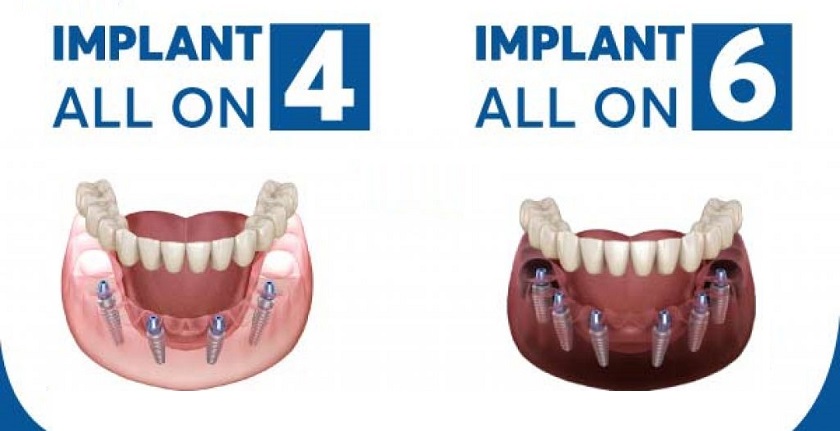 Trồng răng Implant toàn hàm – Giải pháp tối ưu nhất bạn nên lựa chọn