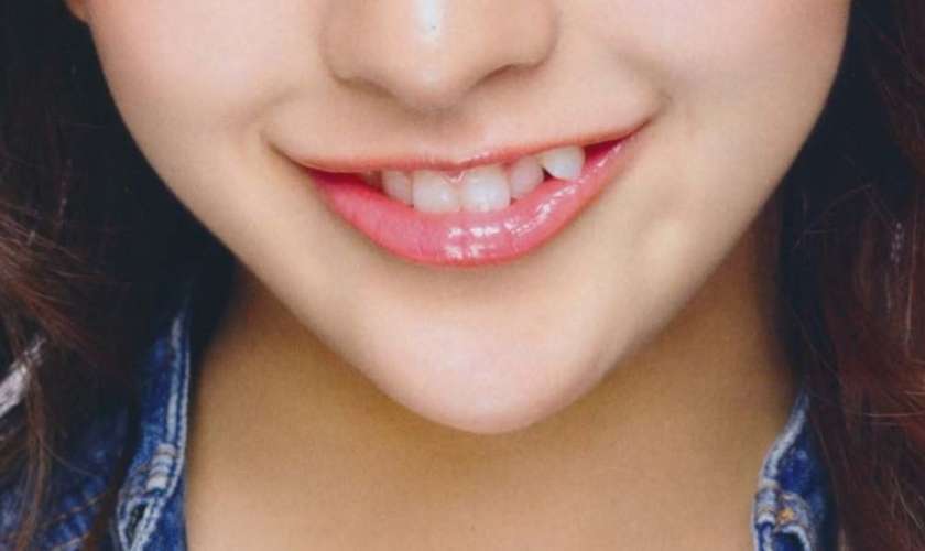 Trồng răng khểnh mang lại cho bạn nụ cười duyên thu hút mọi ánh nhìn