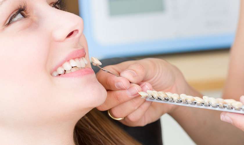 Trồng răng khểnh bằng công nghệ bọc sứ thẩm mỹ