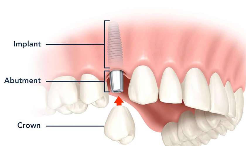 Trồng răng khểnh bằng cấy ghép Implant khá phổ biến hiện nay