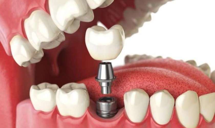 Trụ Implant được cắm vào răng hàm giúp tăng tuổi thọ răng Implant