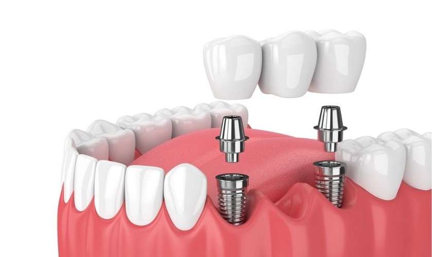 Trồng răng implant giải pháp không làm ảnh hưởng đến các răng bên cạnh