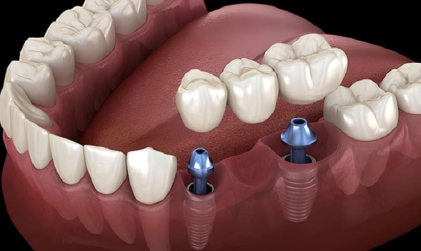 Cầu răng sứ trên Implant