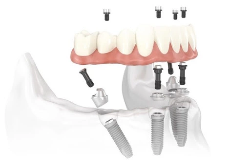 Cấy ghép Implant All On 4