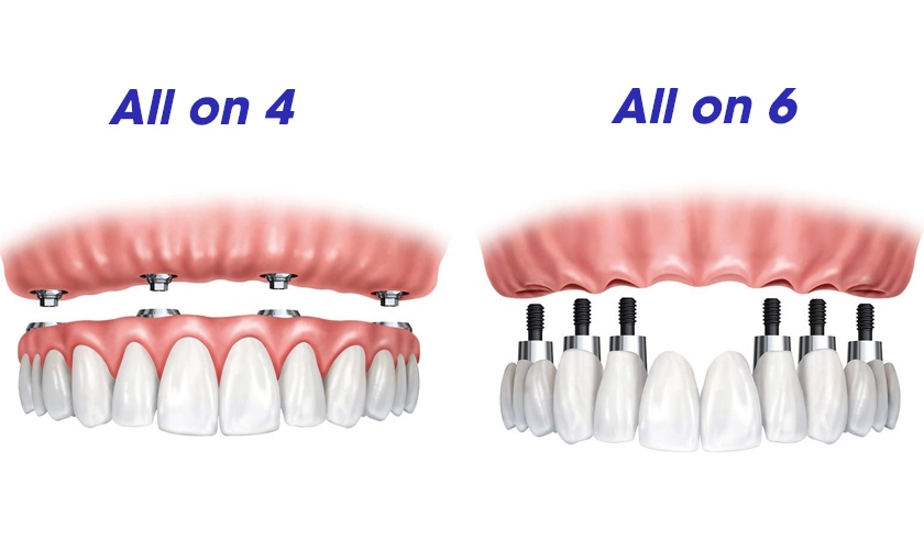 Cấy ghép Implant toàn hàm All on 4/All on 6 giúp tiết kiệm chi phí