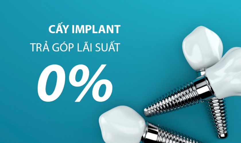 Cấy ghép Implant trả góp là lựa chọn tốt giúp giảm bớt gánh nặng kinh tế