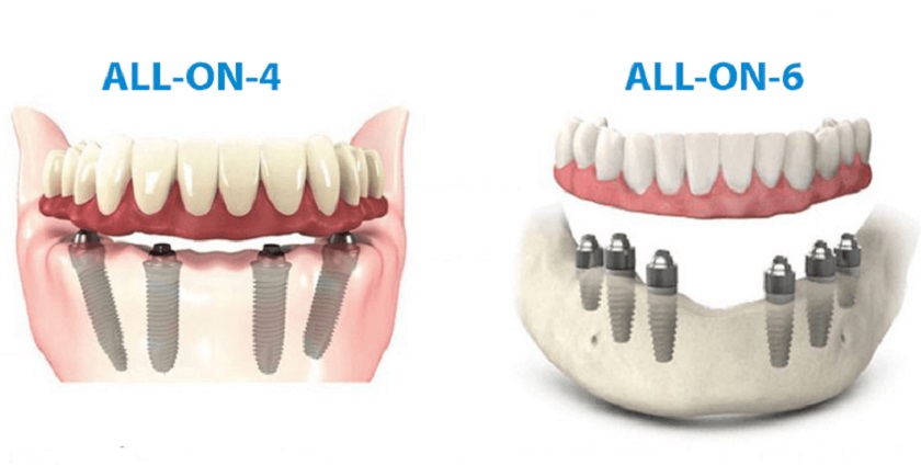 Cấy Implant toàn hàm All on 4 và All on 6
