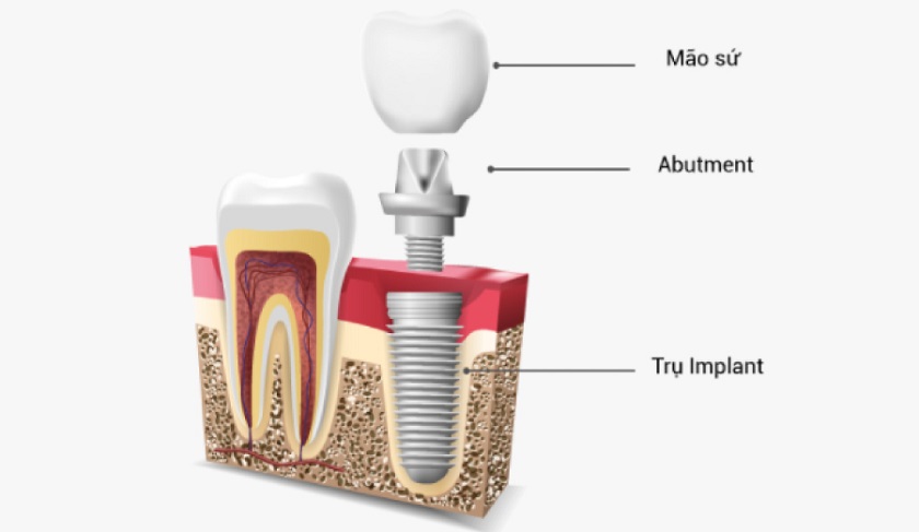 Chi phí cấy ghép Implant bao gồm giá của trụ Implant, Abutment và mão răng sứ là các bộ phận cấu tạo nên răng Implant