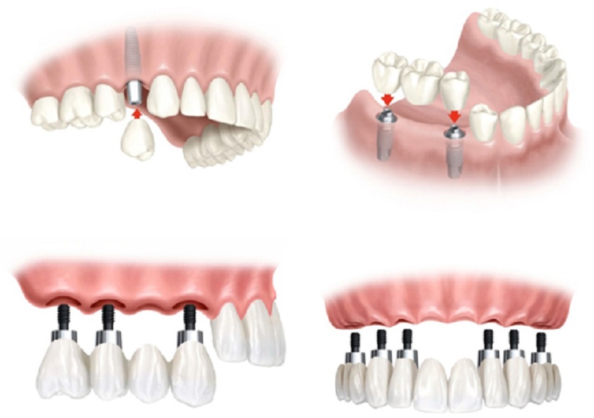 Phương thức cấy ghép sẽ khiến chi phí điều trị của mỗi người khác nhau