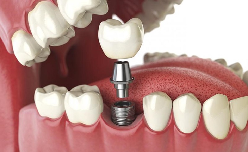 Gắn cố định răng sứ lên Implant thông qua khớp nối