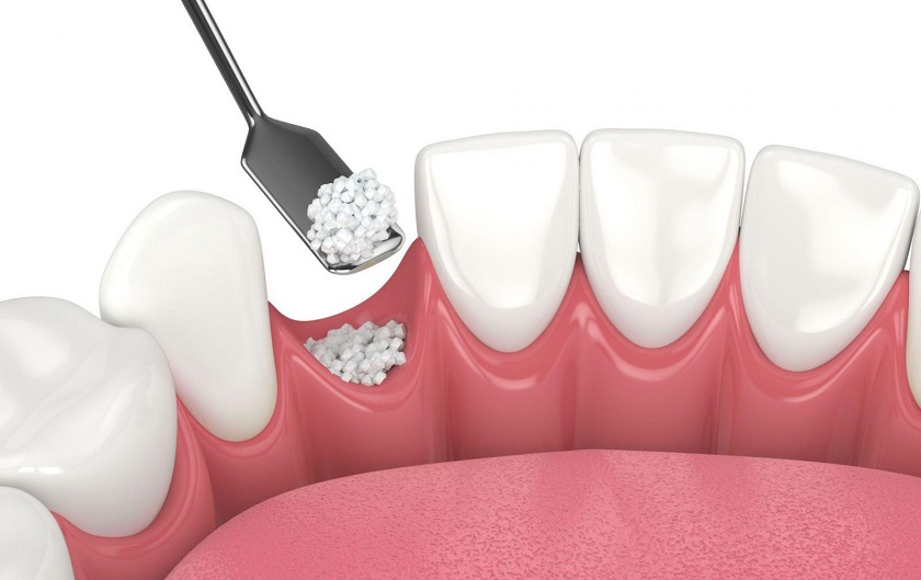 Ghép xương trong trường hợp mất răng lâu năm sẽ làm thời gian cấy ghép Implant kéo dài hơn