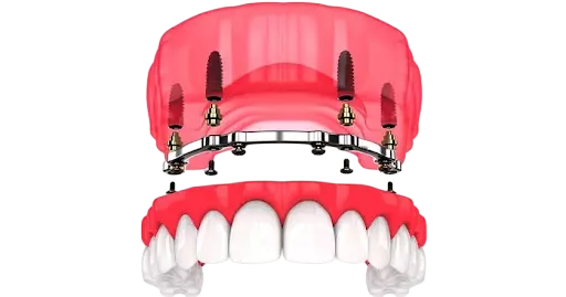 Hàm phủ trên Implant