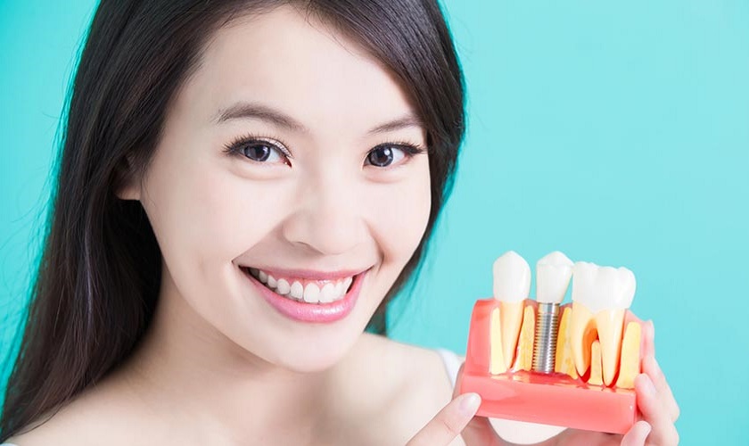 Kỹ thuật cấy ghép Implant khôi phục hoàn hảo răng đã mất