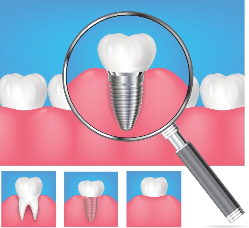 Kỹ thuật trồng răng Implant