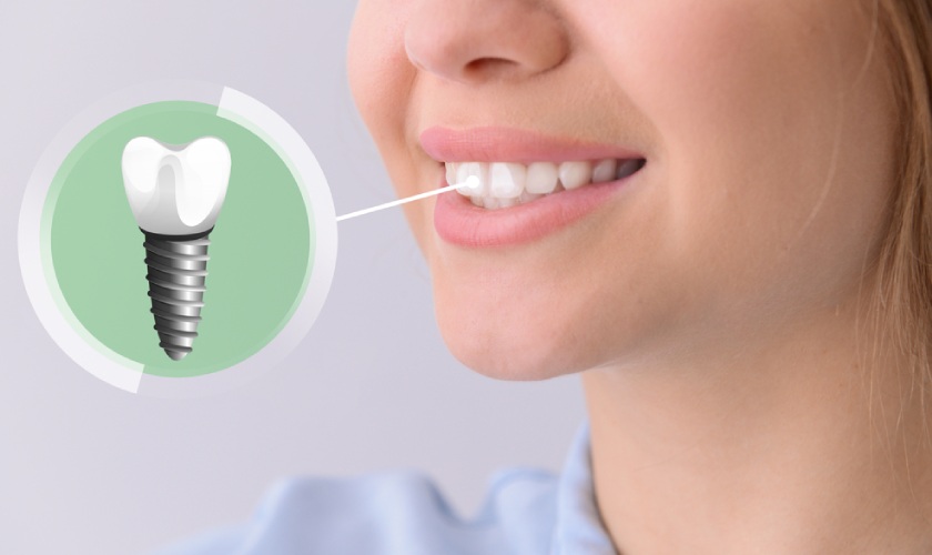 Sở hữu hàm răng khỏe đẹp với kỹ thuật trồng răng Implant