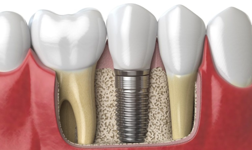 Thời gian trồng răng Implant thường mất khoảng 3 - 6 tháng