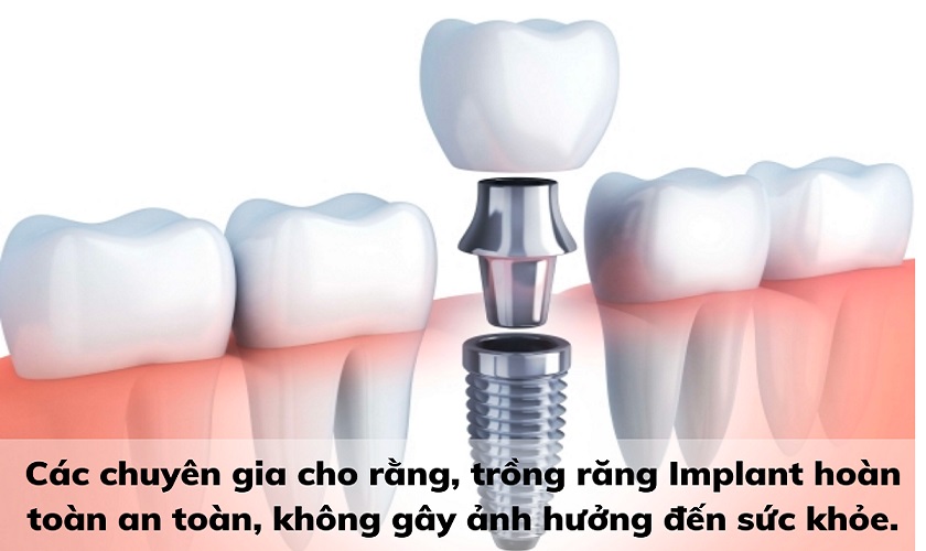 Trồng răng Implant an toàn với sức khỏe khi thực hiện đúng kỹ thuật tại nha khoa uy tín