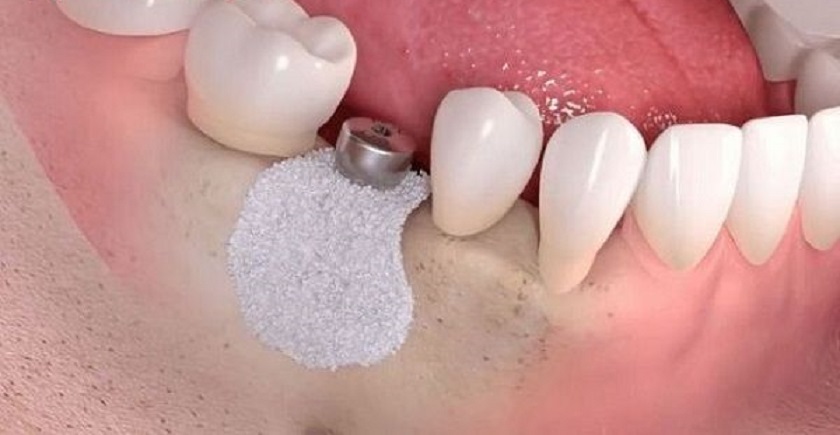 Ghép xương trong trường hợp viêm nha chu nặng gây tiêu xương ổ răng