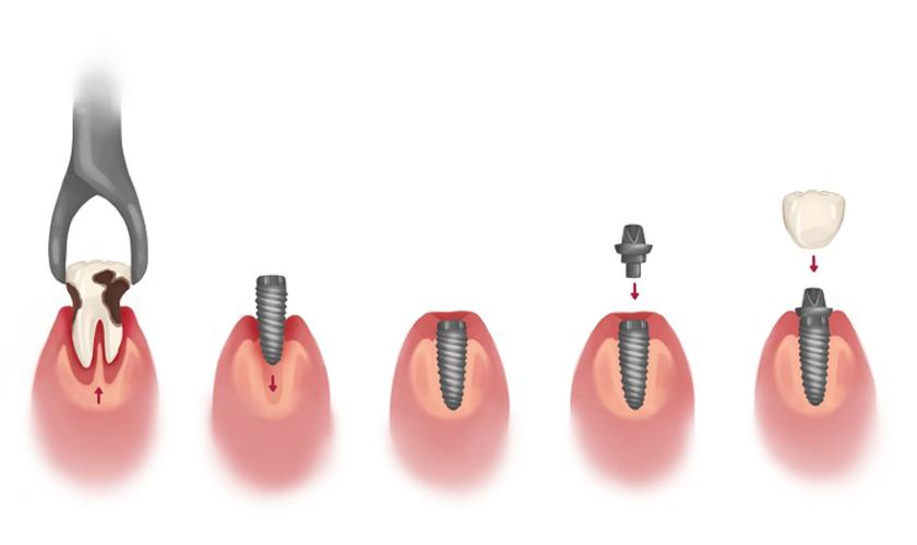 Cắm trụ răng implant kỹ thuật quan trọng trong cấy ghép răng implant