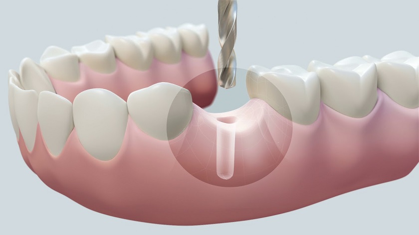 Chân răng Implant được cấy trực tiếp vào xương hàm giúp phòng tránh tiêu xương