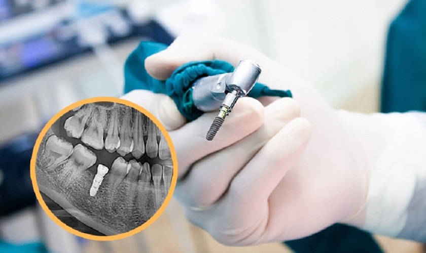 Cấy ghép Implant tại thành phố Hồ Chí Minh