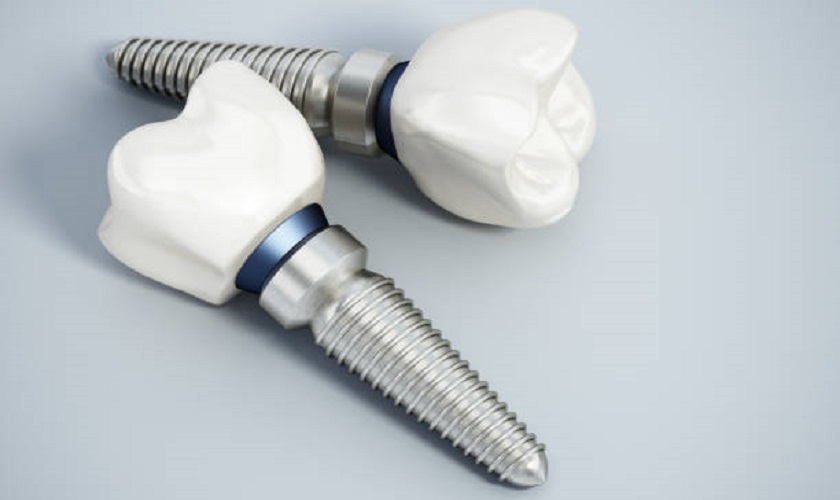 Cấy ghép răng Implant giá bao nhiêu