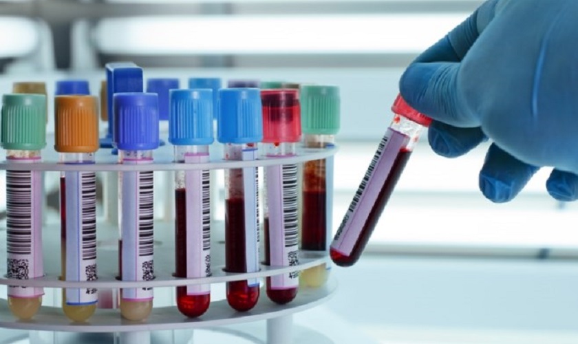 Có cần thiết xét nghiệm máu khi trồng răng Implant không?