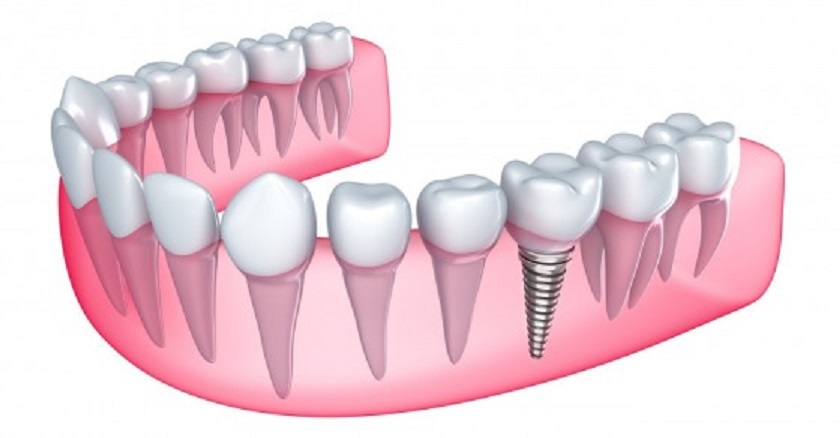 Cấy ghép răng Implant