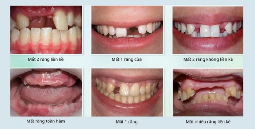 Cấy ghép răng Implant có thể khắc phục hầu hết các tình huống mất răng