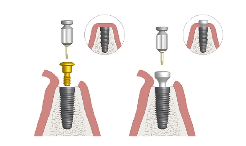 Healing Abutment giúp bảo đảm sự thành công của ca phục hình răng