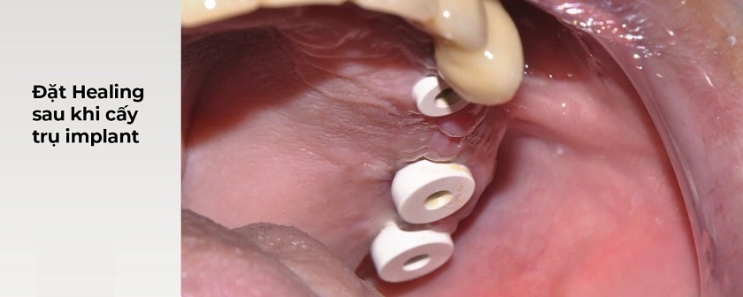 Hình ảnh một ca lâm sàng sau khi đặt trụ lành thương và hoàn thiện cấy ghép Implant