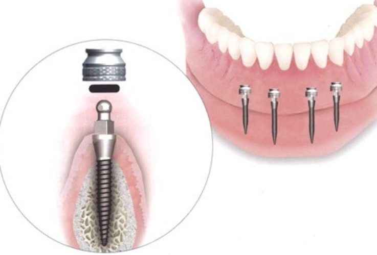 Healing có vai trò gì trong cấy ghép Implant?