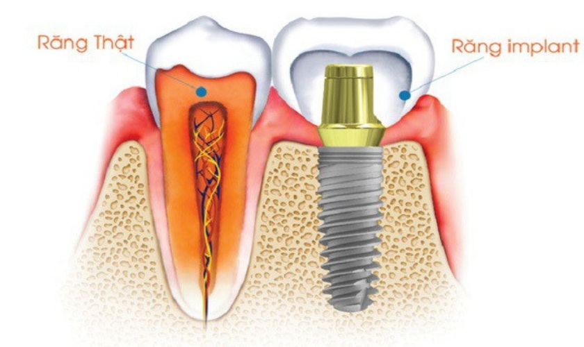 Implant ETK Pháp