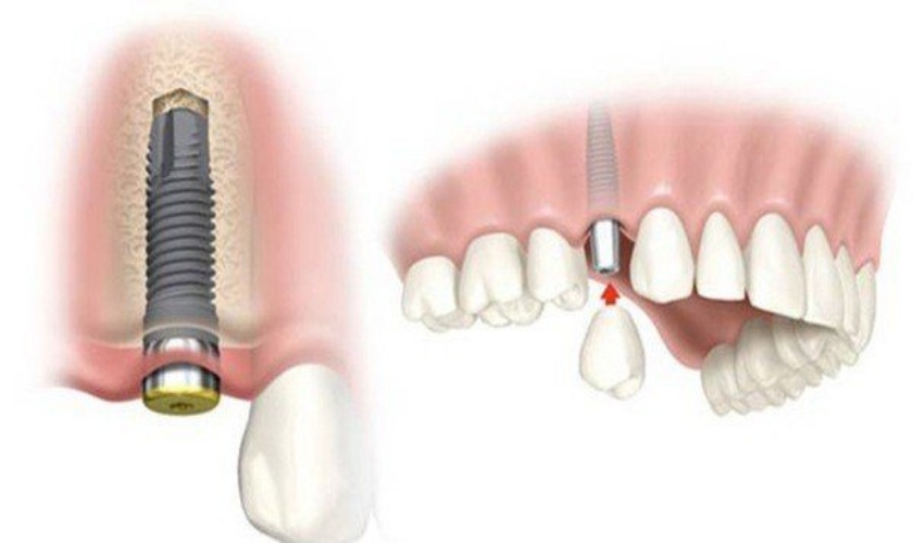 Nếu cấy ghép đúng kỹ thuật và vệ sinh đúng cách Implant ETK có thể tồn tại vĩnh viễn