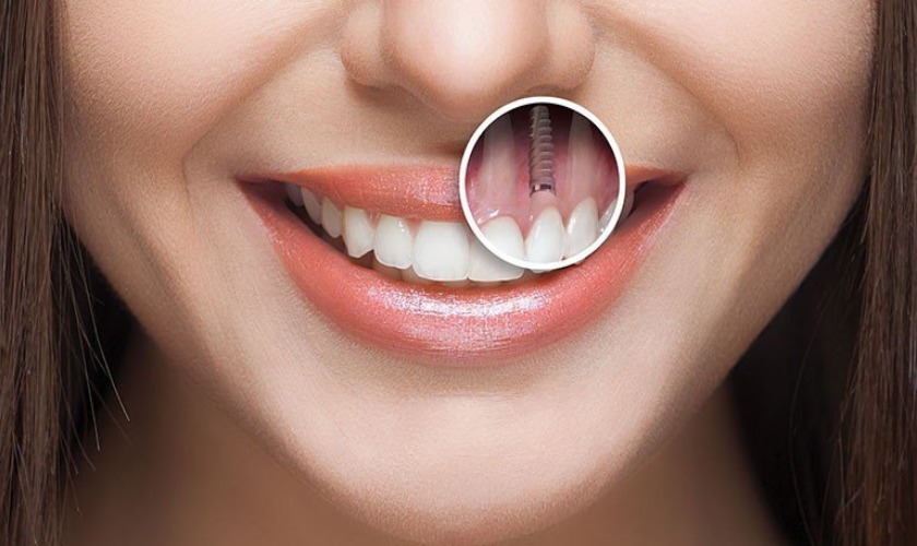 Sở hữu nụ cười tự tin với Implant Hiossen