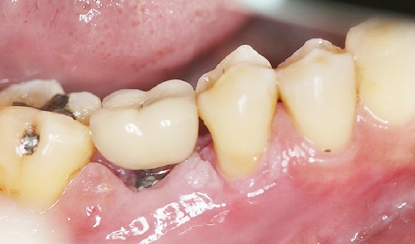 Biểu hiện thất bại khi trồng răng Implant