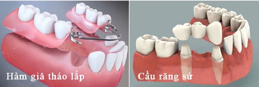 Bác sĩ có thể tư vấn khách hàng làm cầu răng sứ hoặc răng giả tháo lắp để thay thế trong một số trường hợp