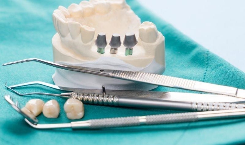 Kỹ thuật cấy ghép răng hiện nay