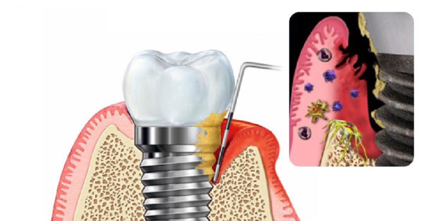 Làm răng Implant giá rẻ thường sử dụng trụ chân răng kém chất lượng