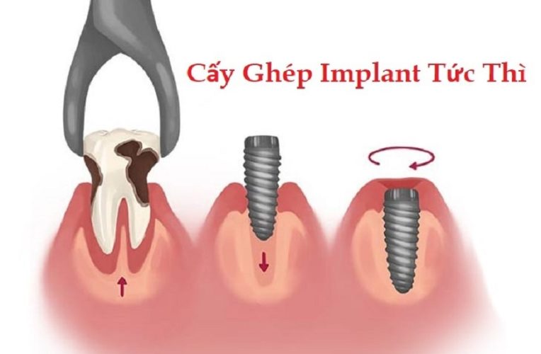 Cấy ghép Implant tức thì sau nhổ răng