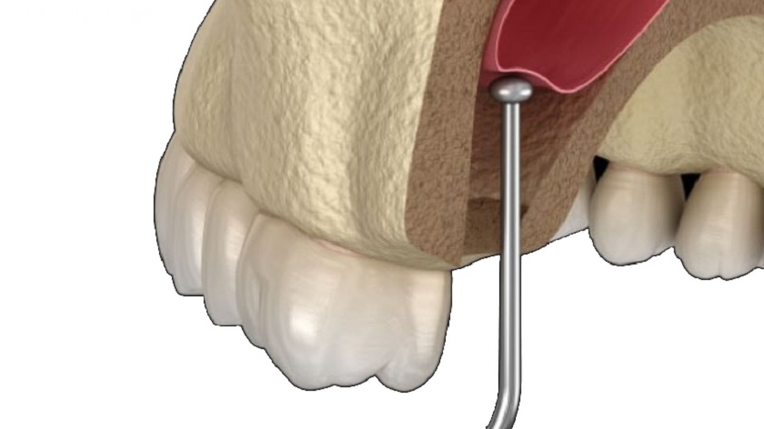 Nâng xoang hàm trong trường hợp mất răng lâu năm, xoang hàm hạ thấp