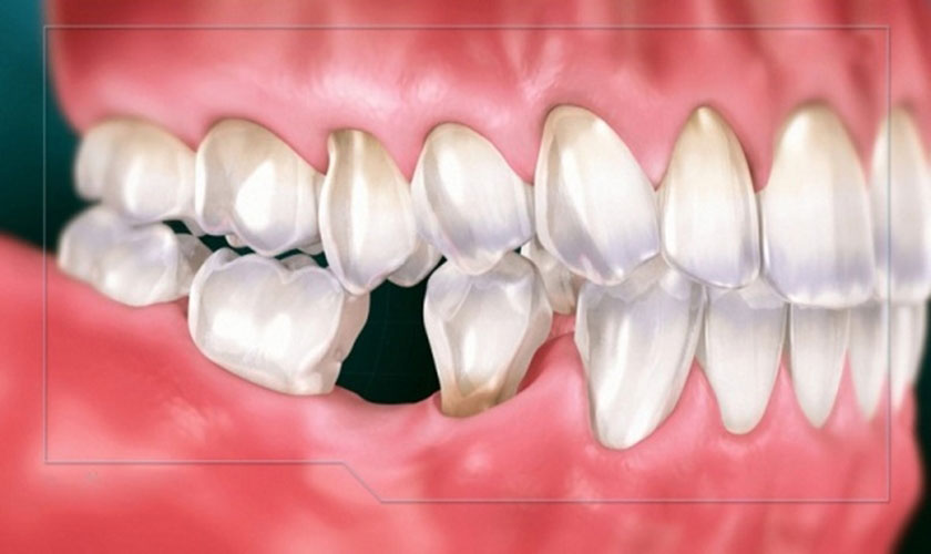 Mất răng khiến răng bị xô lệch