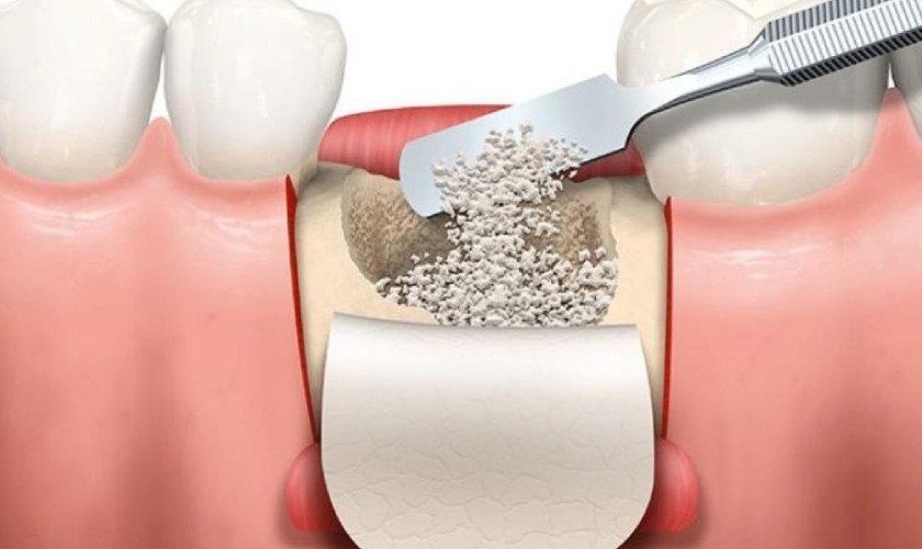 Ghép xương trong cấy ghép Implant