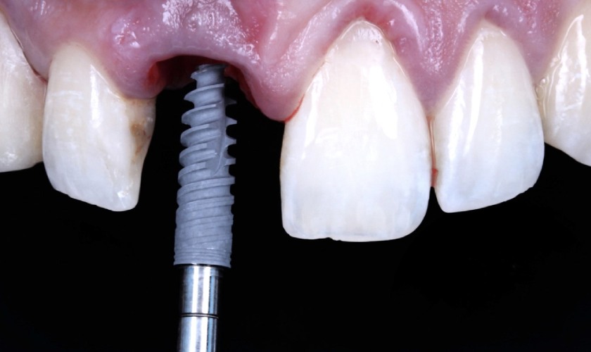 Cấy ghép Implant là giải pháp lý tưởng giúp ngăn ngừa tiêu xương do mất răng