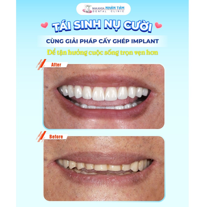 Nụ cười của khách hàng khi cấy ghép Implant tại Implant Center