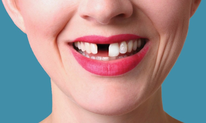 Mất răng cửa gây mất thẩm mỹ cho khuôn mặt
