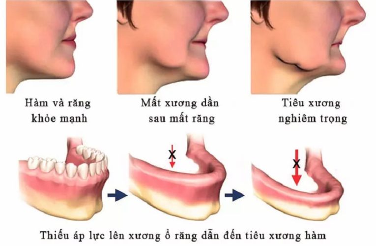 Tiêu xương hàm do mất răng không trồng lại