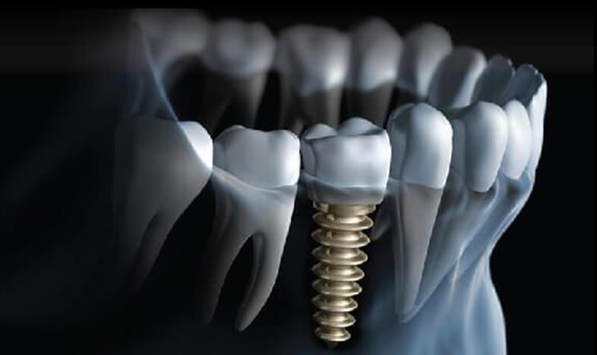 Cấy ghép răng Implant